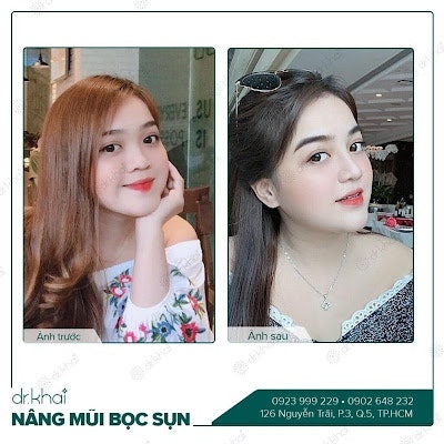 nâng mũi bọc sụn