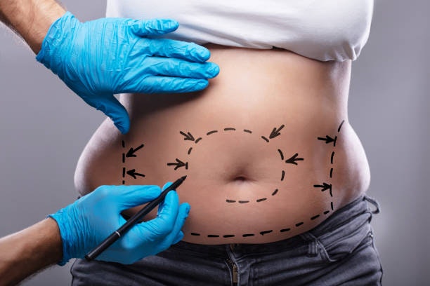 Liposuction in Riyadh